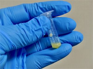 爪の検体を完全に溶解して白癬菌の有無を調べます