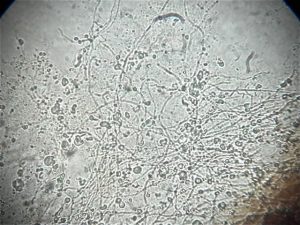溶解した爪で観察される白癬（水虫）菌